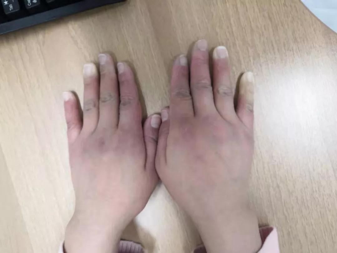 “手指、腳趾發(fā)白、發(fā)紫……”這些“小毛病”千萬別大意