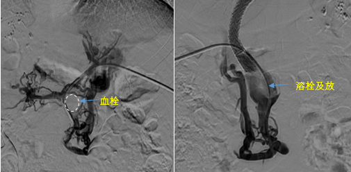 血栓攔路，如何破局——罕見巨大門靜脈血栓TIPS手術(shù)實(shí)錄