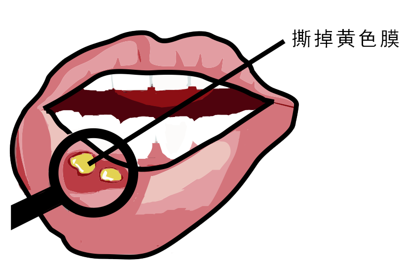 經(jīng)?？谇粷?，真的只是缺維生素嗎？