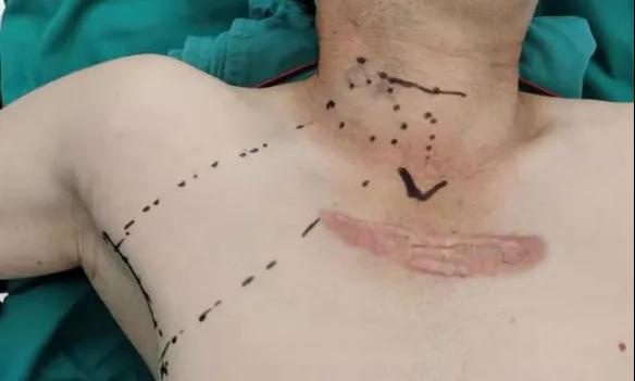 術(shù)后傷口可以“隱身”嗎？