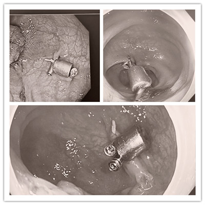 消化病醫(yī)院內(nèi)外科聯(lián)合開展3例“磁環(huán)預(yù)標(biāo)記輔助腹腔鏡結(jié)、直腸癌根治術(shù)”