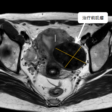 保子宮、保留生育功能—磁波刀治療子宮肌瘤