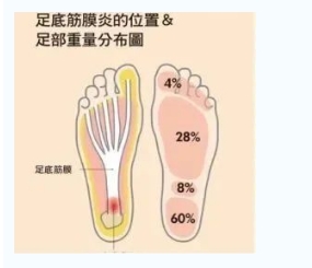 每年新生數(shù)百萬足底筋膜炎患者！國(guó)際醫(yī)學(xué)專家提醒：跑步要選擇合適的鞋