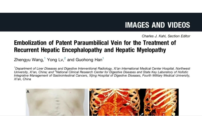 我院護(hù)理團(tuán)隊(duì)臨床成果登榜國際肝病權(quán)威期刊，影響因子11.6