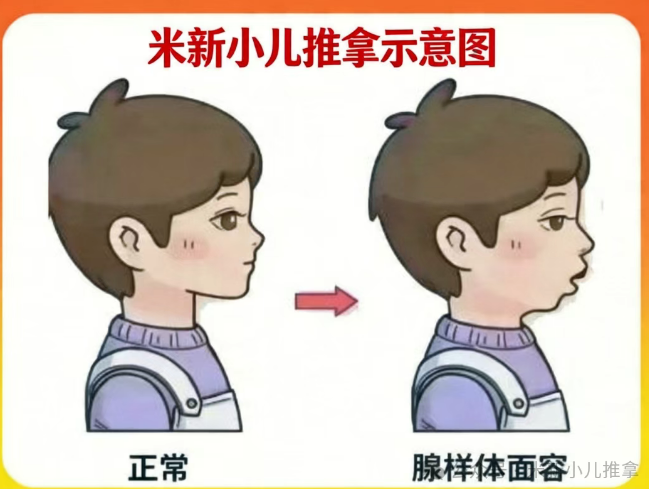 兒童腺樣體肥大只能手術(shù)？不，一位媽媽的親身經(jīng)歷給出另一種答案